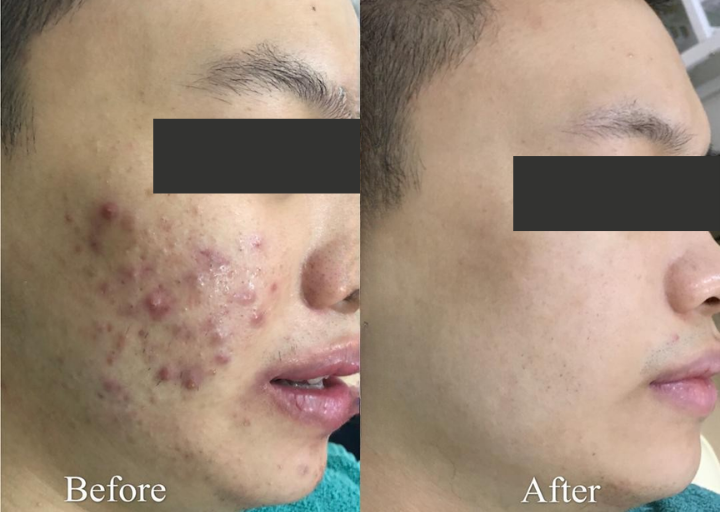 Pore Refining Result