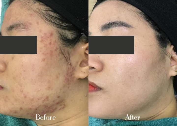 Pore Refining Before