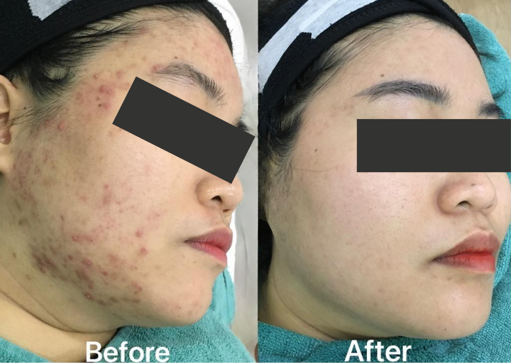 Pore Refining Result