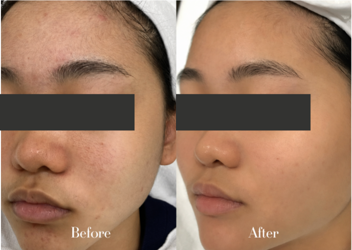 Pore Refining Before