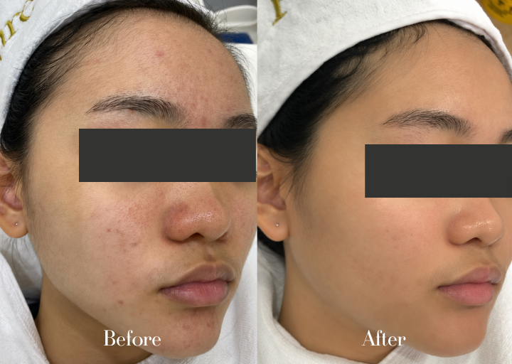 Pore Refining Result