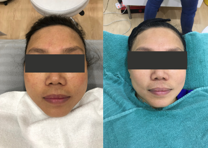 Pigmentation Reset Before and After 2