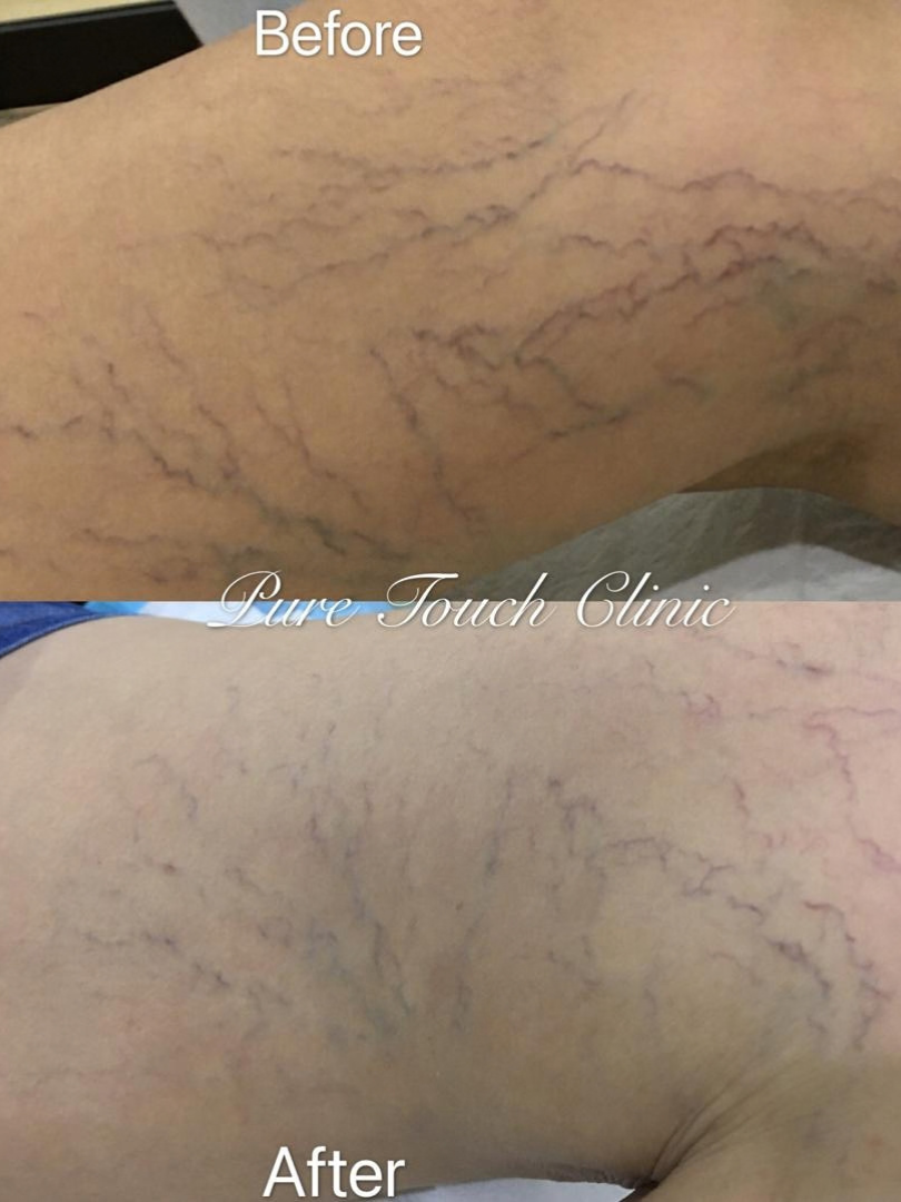 Sclerotherapy Treatment Before and After Result 2