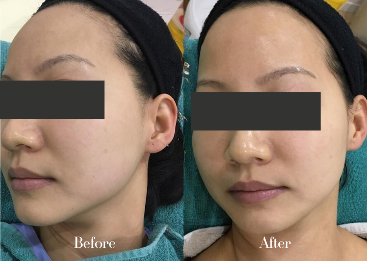 Before and After