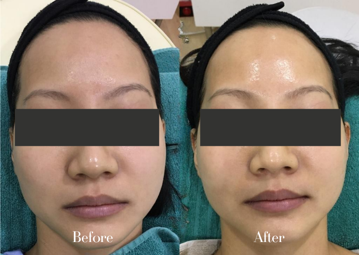 Before and After Progress