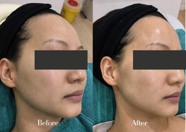 Before and After Result