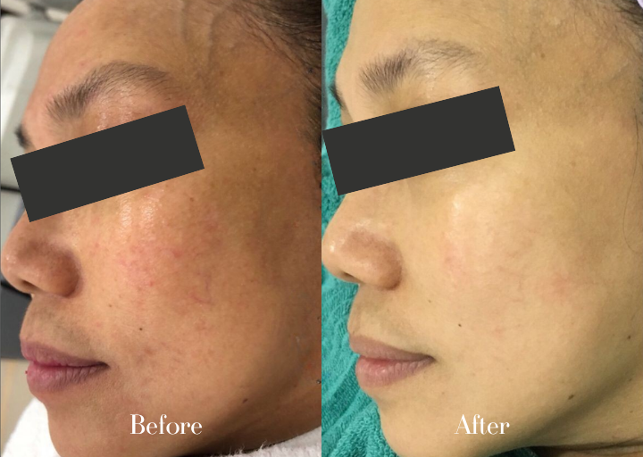 Before and After