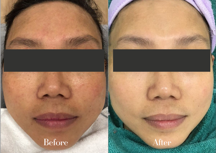 Before and After Progress