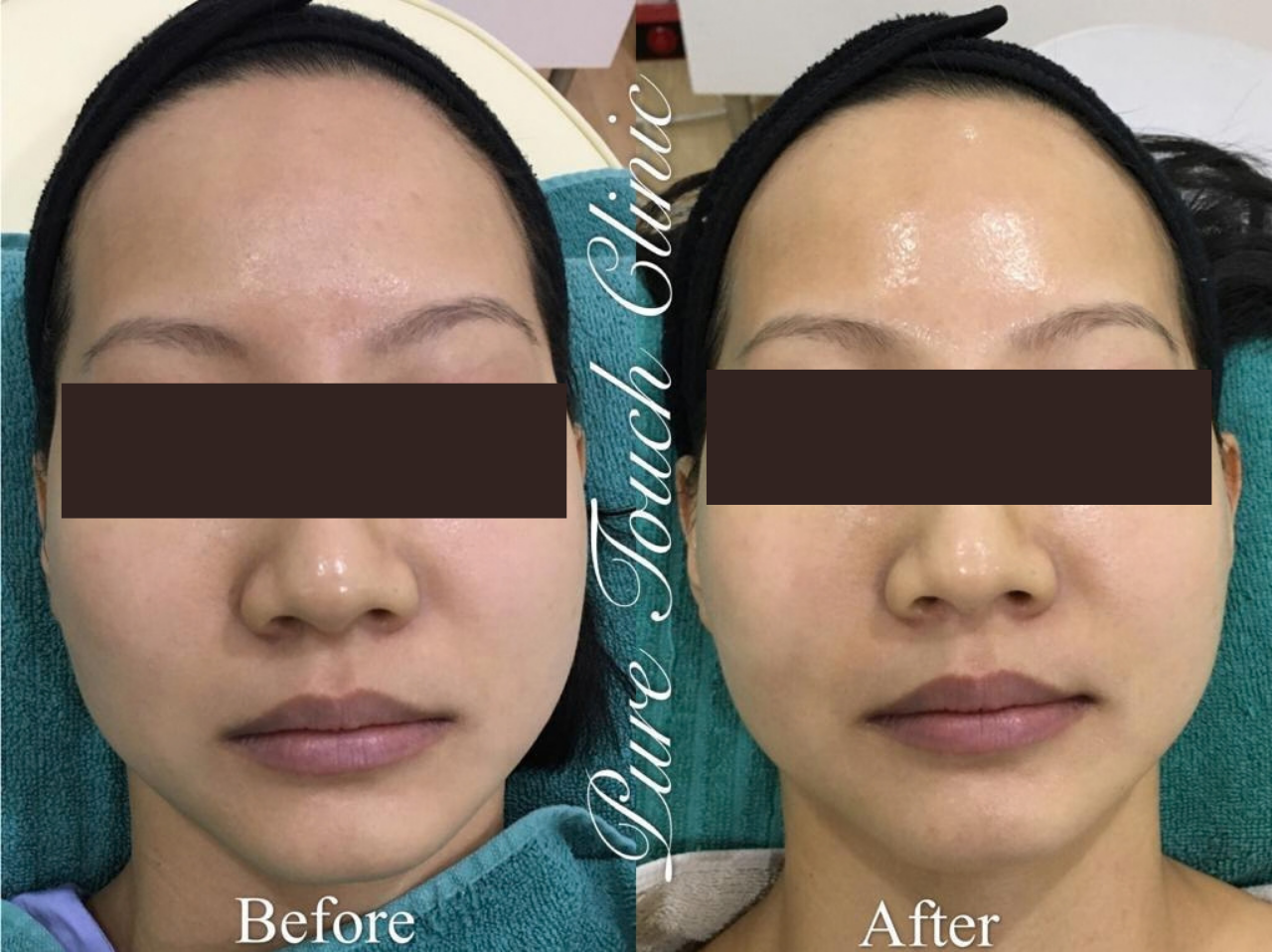 Advanced Brightening Program Before and After Result 1