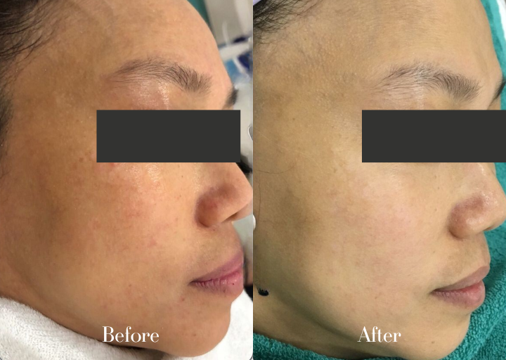 Before and After Result