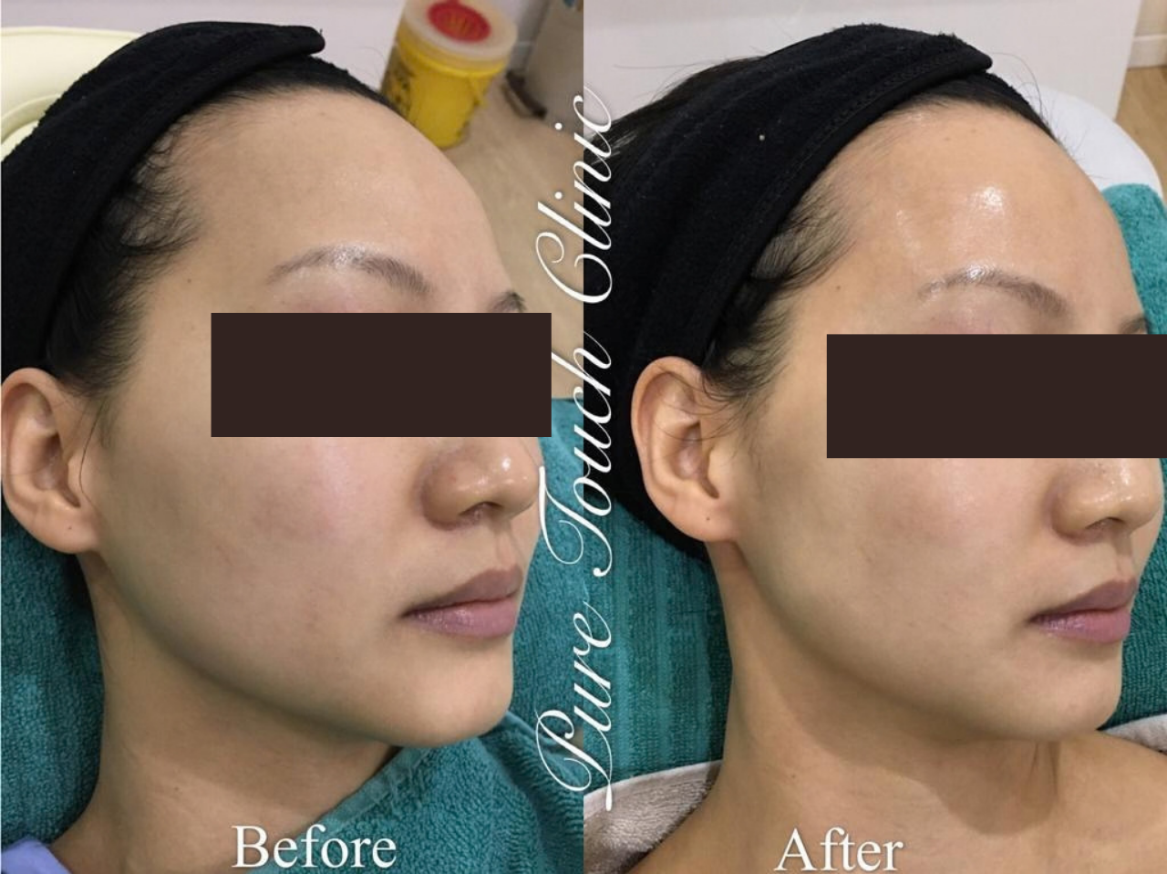 Advanced Brightening Program Before and After Result 2