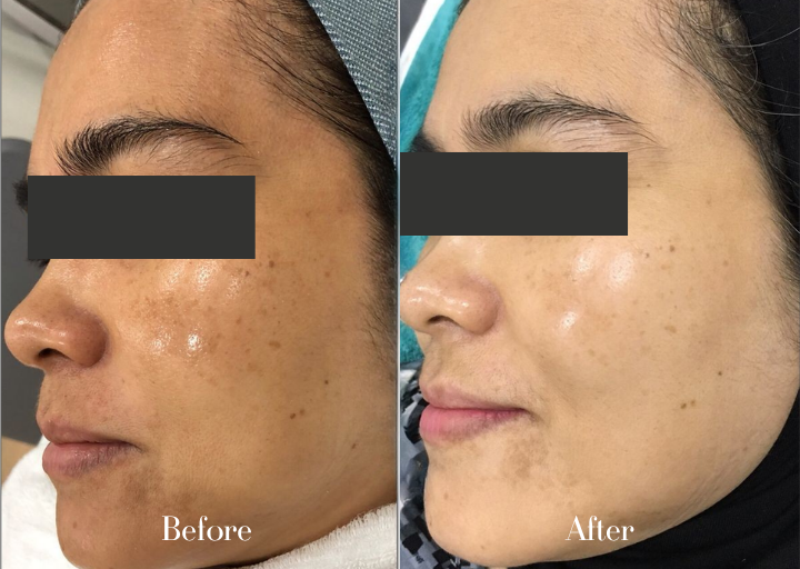 Before and After Progress