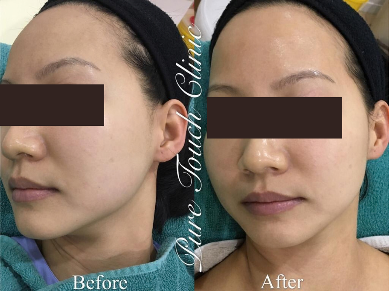 Advanced Brightening Program Before and After Result 3
