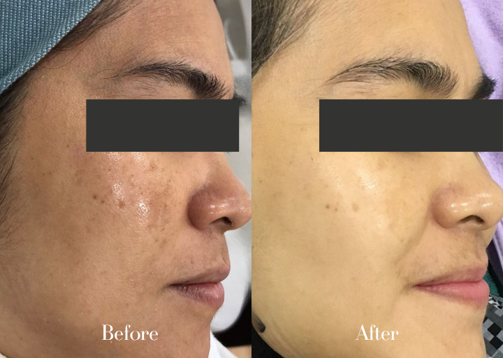 Before and After Result