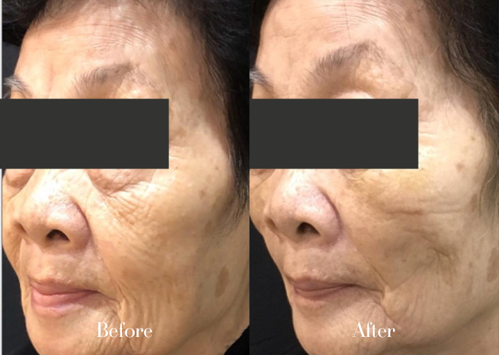 Thread Lift Before and After Result 2