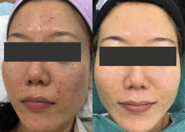 Pigmentation Reset Before and After 3