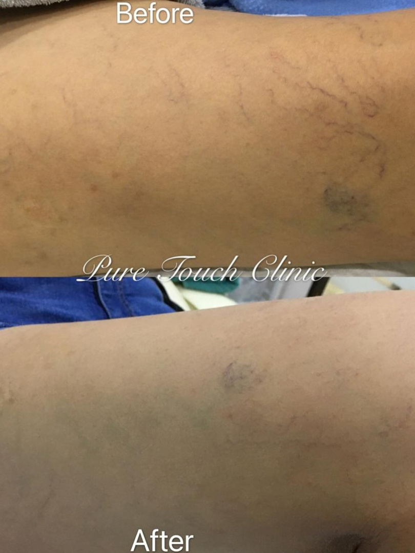 Sclerotherapy Treatment Before and After Result 3