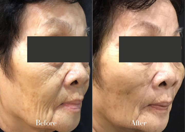 Thread Lift Before and After Result 1