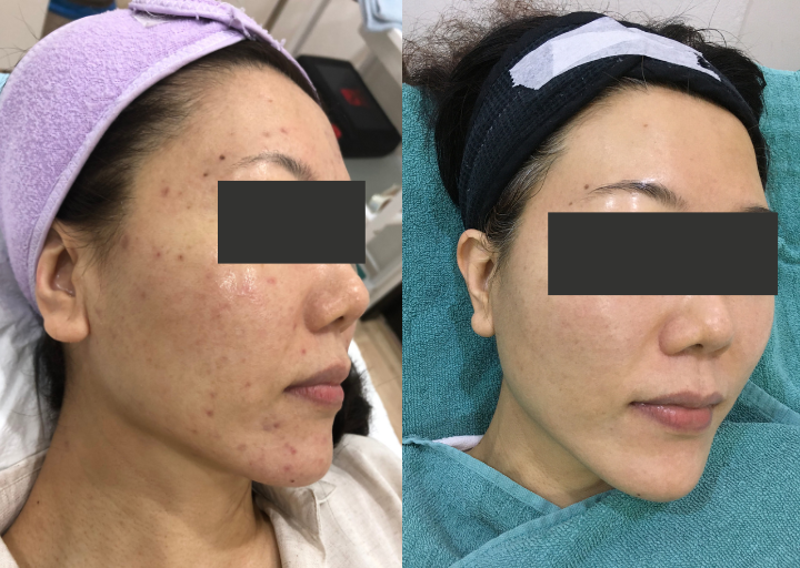 Pigmentation Reset Before and After 4