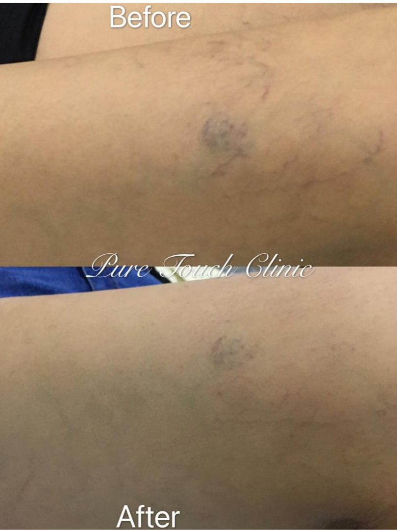 Sclerotherapy Treatment Before and After Result 4