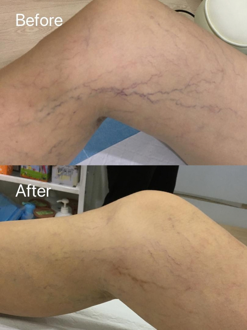 Sclerotherapy Treatment Before and After Result 5
