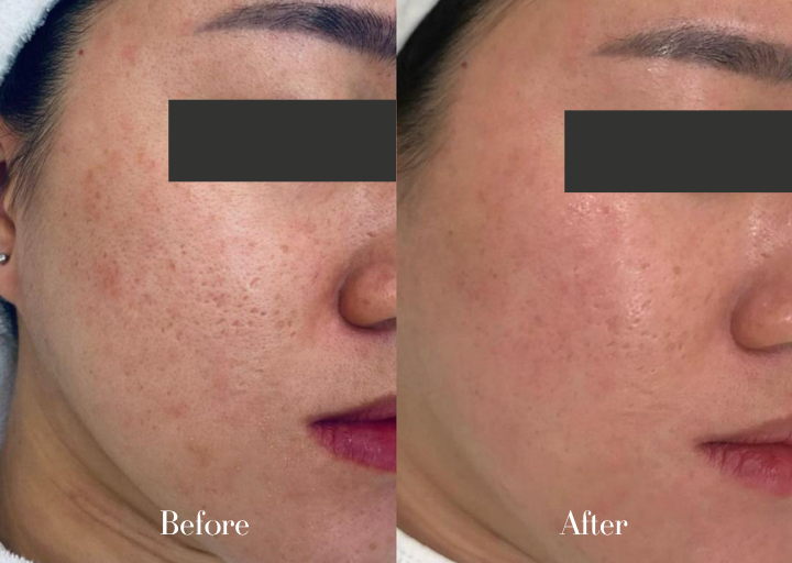 Acne Treatment Result 1 Before