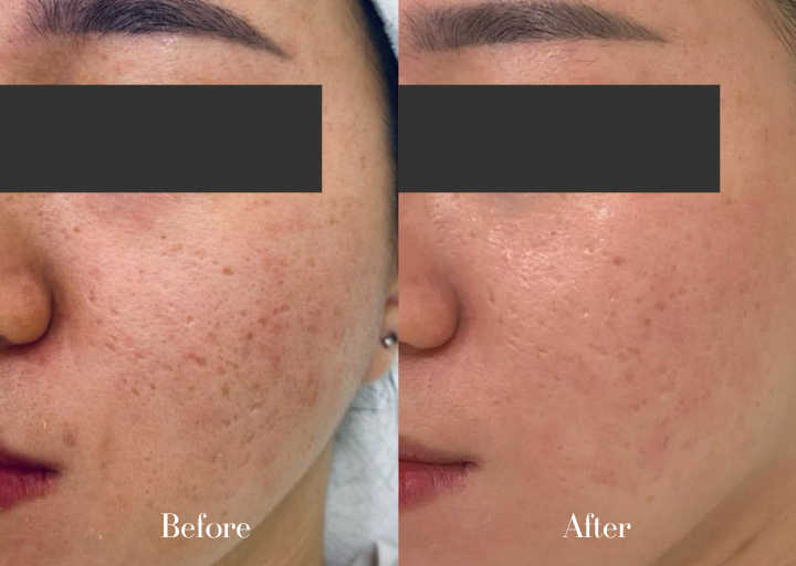 Acne Treatment Result 1