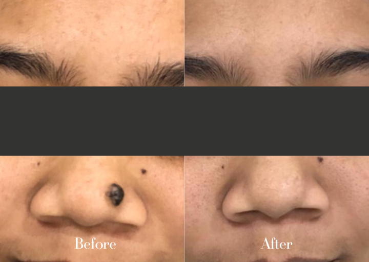 Before and After