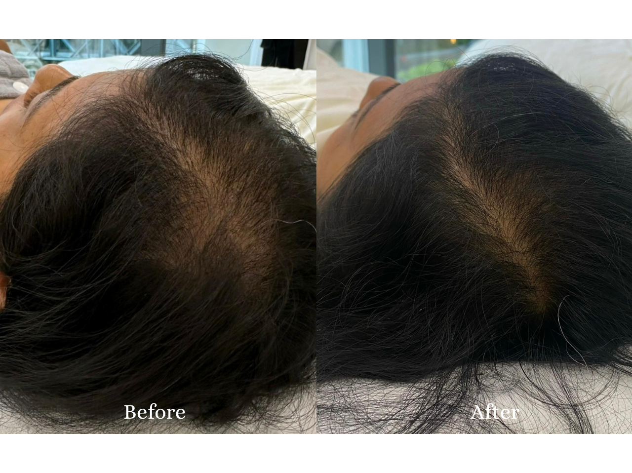 Hair Restoration Before and After Result 1