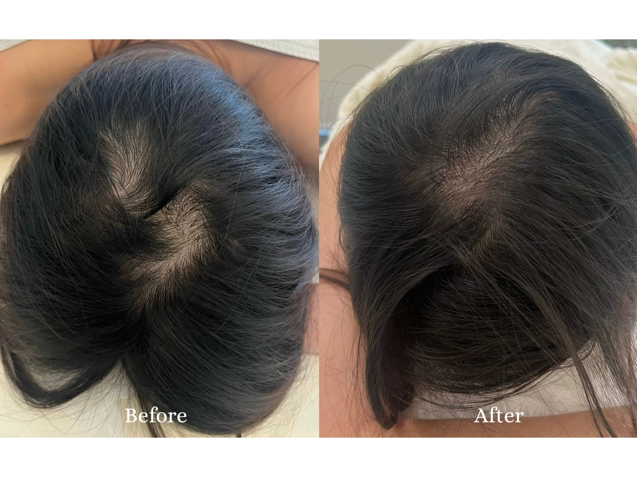 Hair Restoration Before and After Result 2
