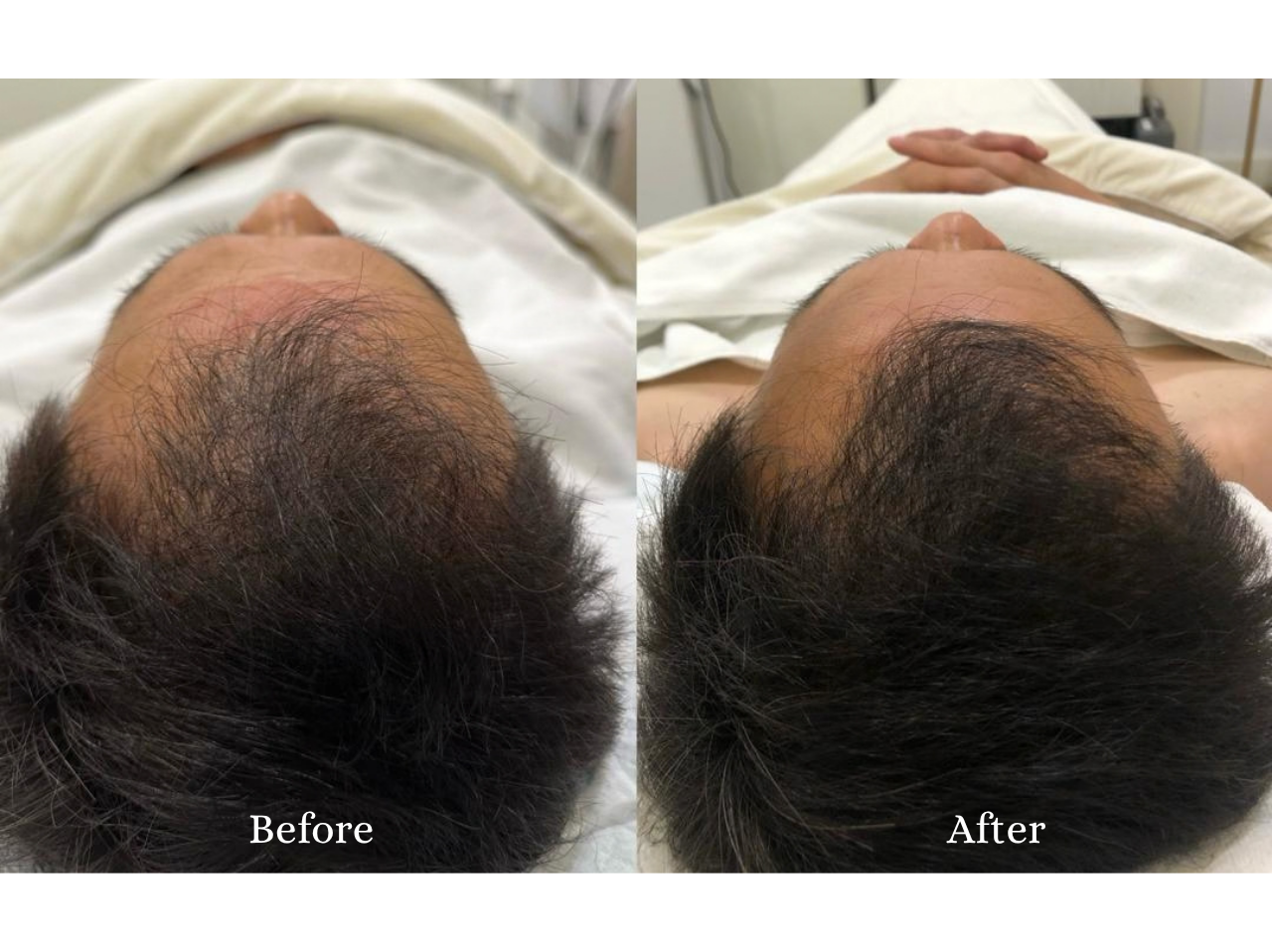Hair Restoration Before and After Result 3