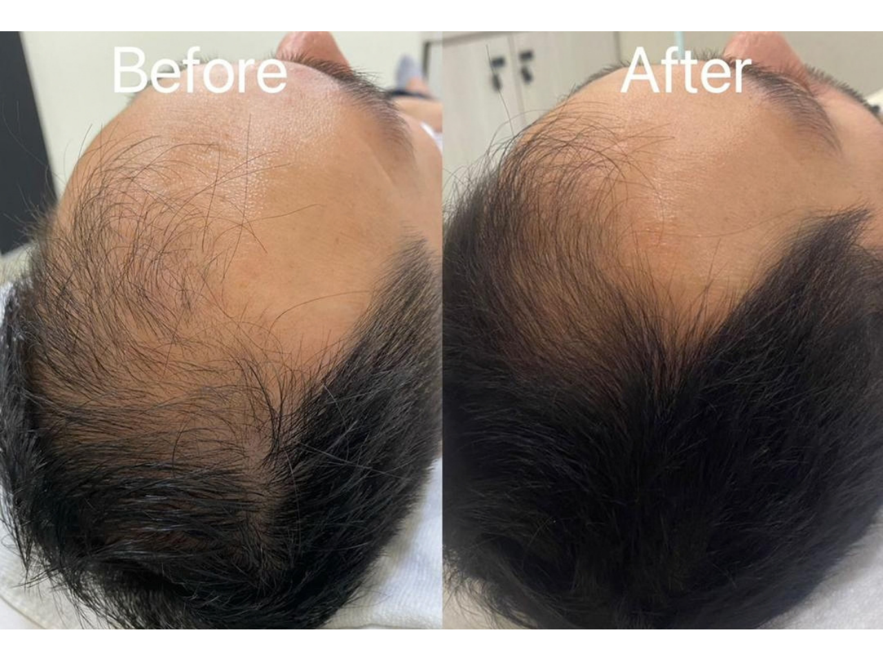 Hair Restoration Before and After Result 7