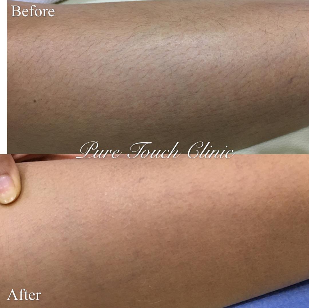 Permanent Hair Reduction Before and After Result 1